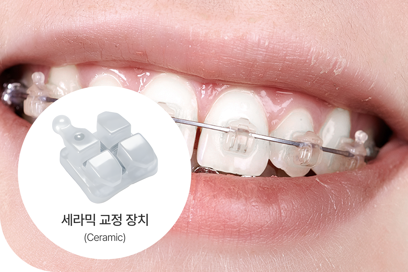 세라믹교정