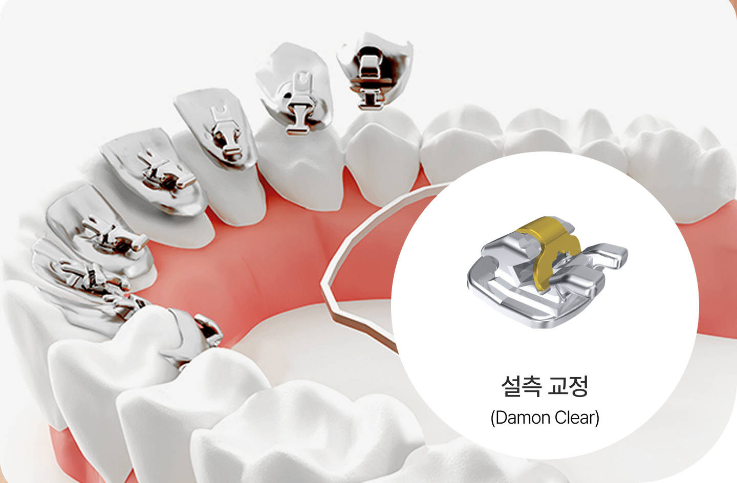 설측교정