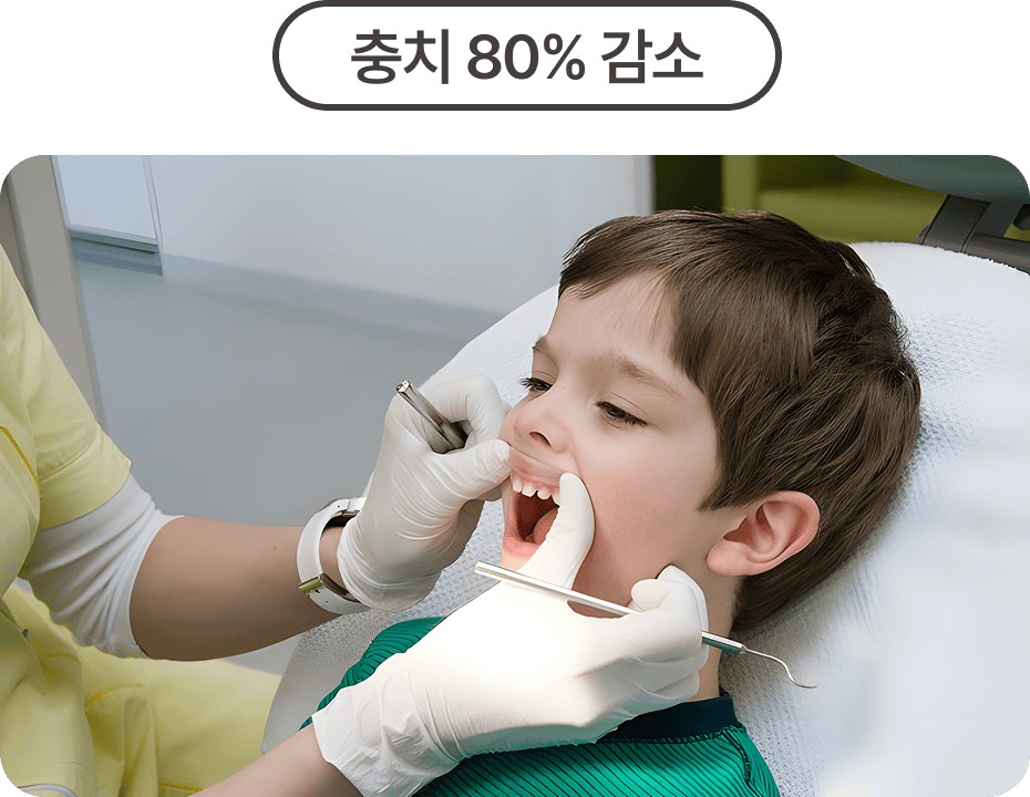 실란트